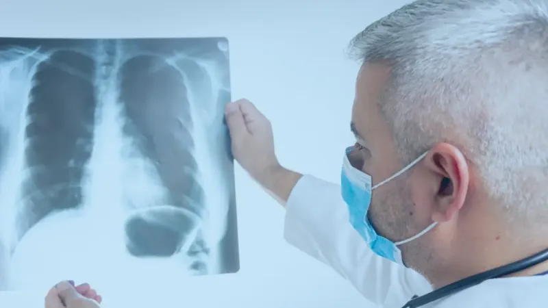SUS amplia tratamento com três novos medicamentos para câncer de pulmão
